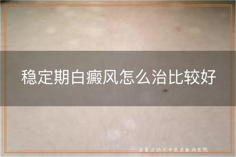 稳定期白癜风怎么治比较好
