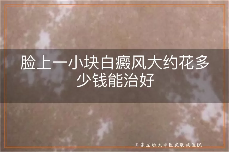 脸上一小块白癜风大约花多少钱能治好