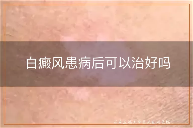 白癜风患病后可以治好吗