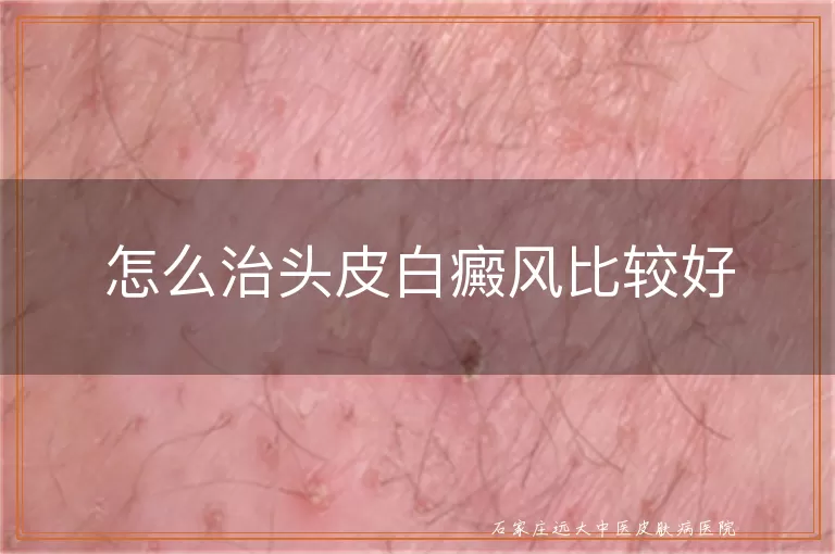 怎么治头皮白癜风比较好
