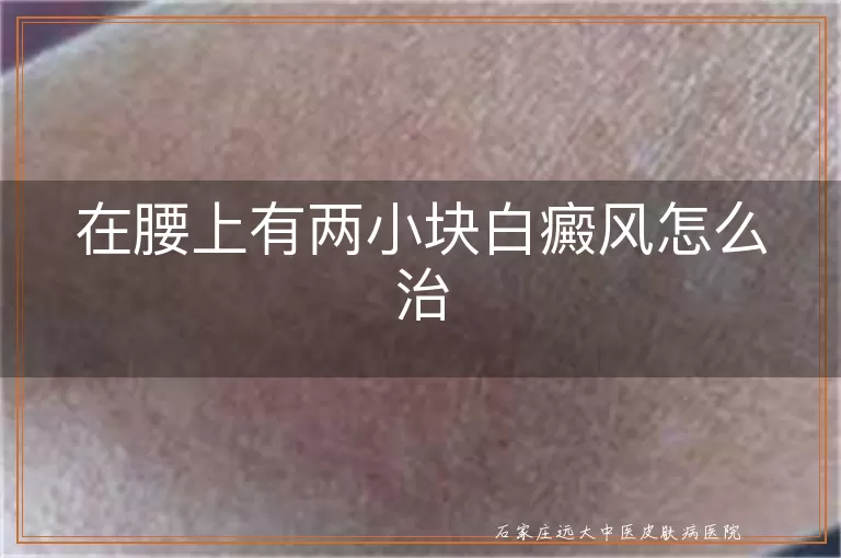 在腰上有两小块白癜风怎么治