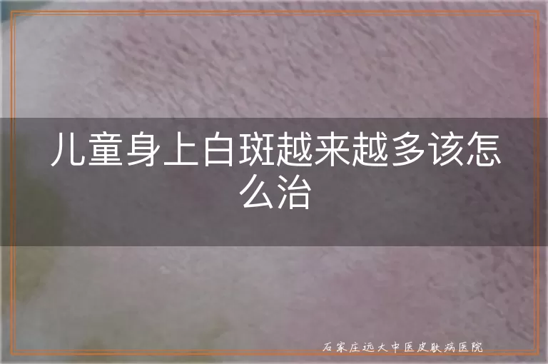 儿童身上白斑越来越多该怎么治