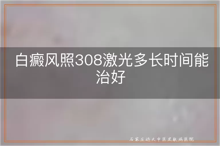 白癜风照308激光多长时间能治好