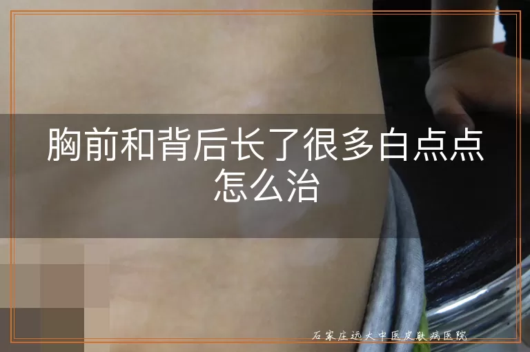 胸前和背后长了很多白点点怎么治