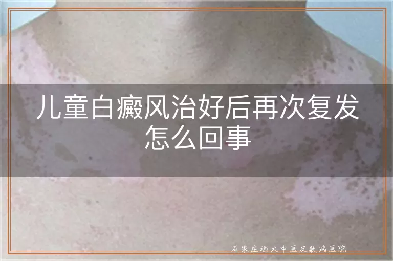 儿童白癜风治好后再次复发怎么回事