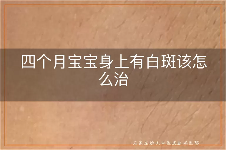 四个月宝宝身上有白斑该怎么治