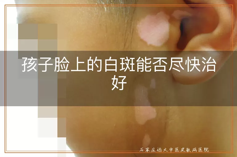 孩子脸上的白斑能否尽快治好