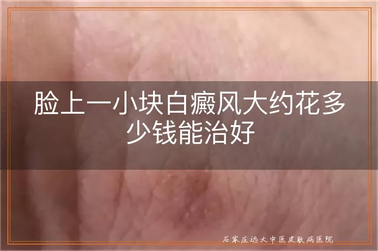 脸上一小块白癜风大约花多少钱能治好