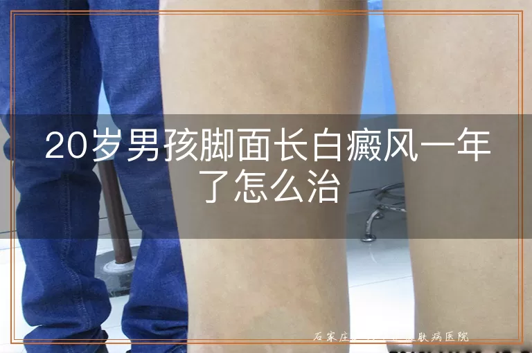 20岁男孩脚面长白癜风一年了怎么治