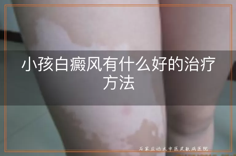 小孩白癜风有什么好的治疗方法