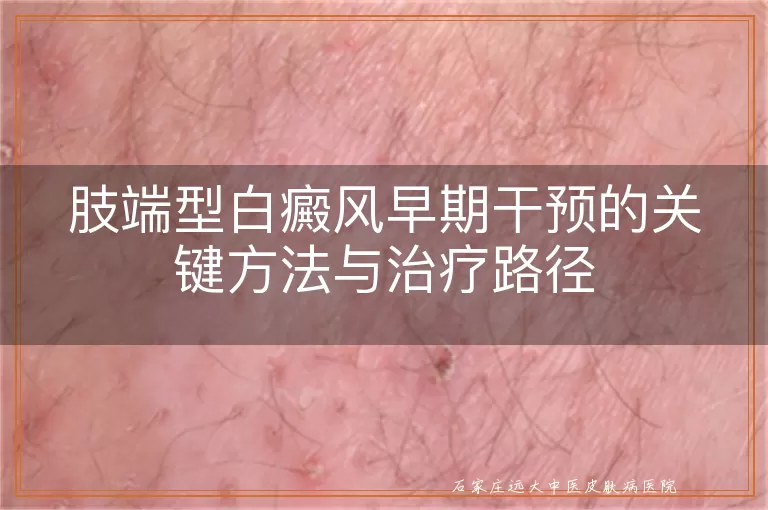 肢端型白癜风早期干预的关键方法与治疗路径