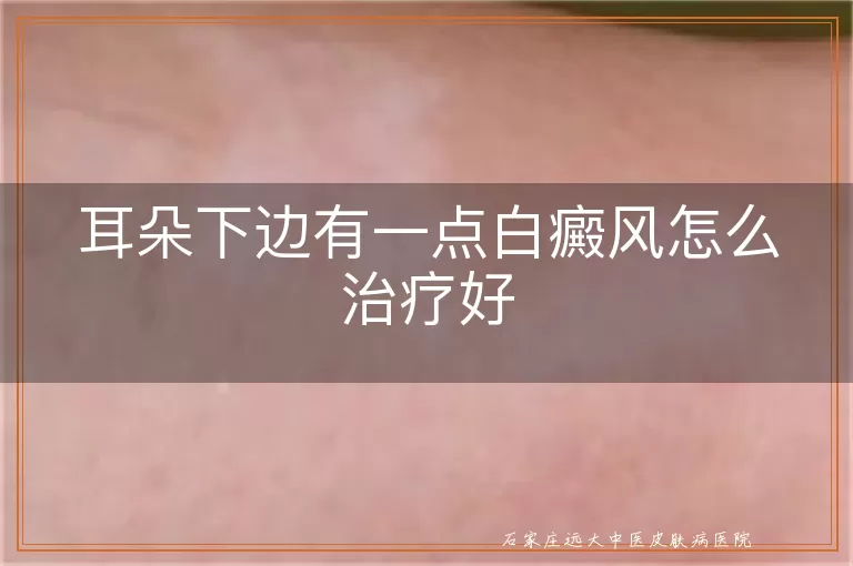 耳朵下边有一点白癜风怎么治疗好