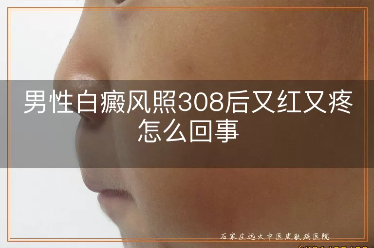 男性白癜风照308后又红又疼怎么回事