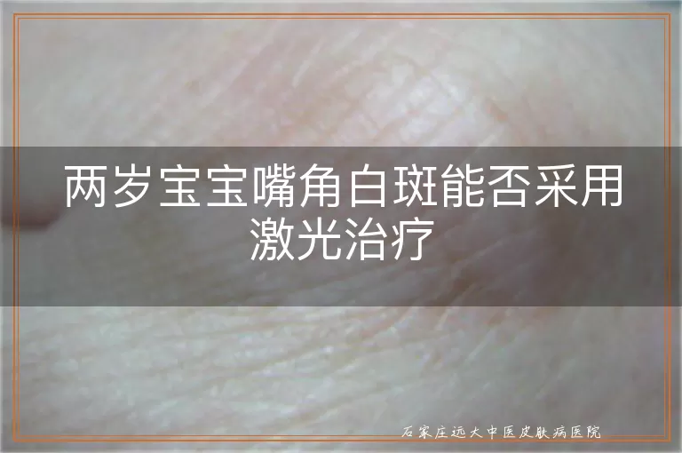 两岁宝宝嘴角白斑能否采用激光治疗