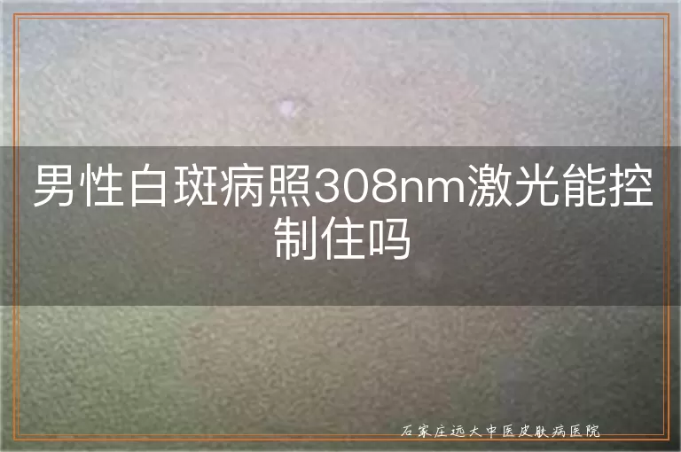 男性白斑病照308nm激光能控制住吗