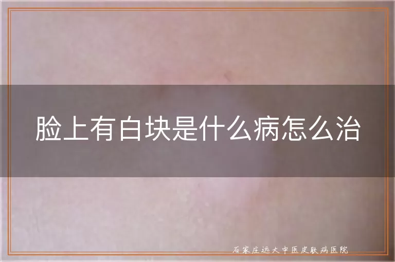 脸上有白块是什么病怎么治