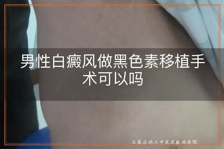 男性白癜风做黑色素移植手术可以吗