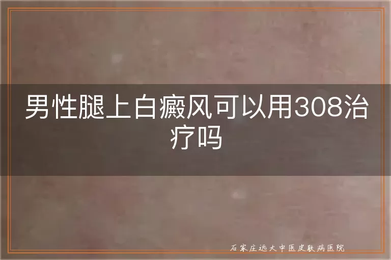 男性腿上白癜风可以用308治疗吗