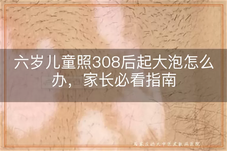 六岁儿童照308后起大泡怎么办，家长必看指南