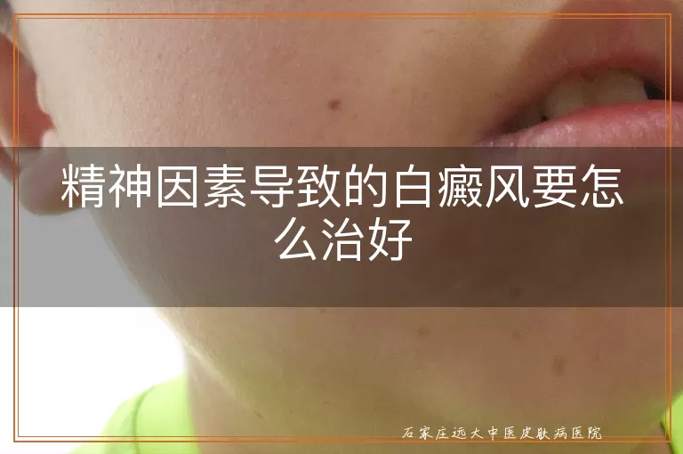 精神因素导致的白癜风要怎么治好