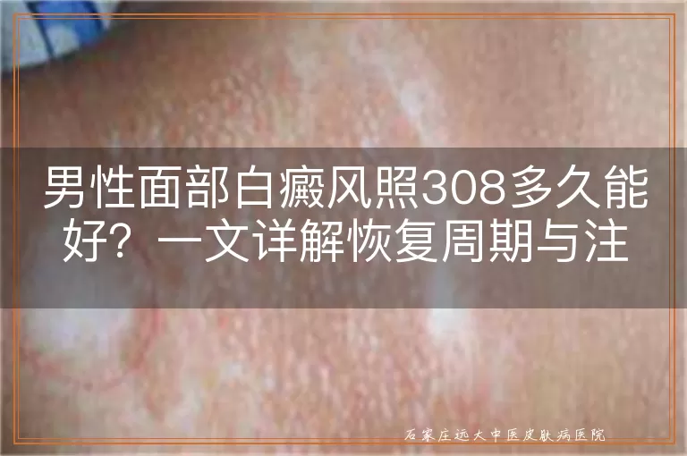 男性面部白癜风照308多久能好？一文详解恢复周期与注意事项