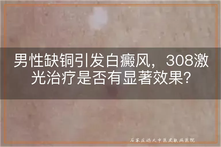 男性缺铜引发白癜风，308激光治疗是否有显著效果？
