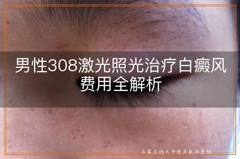 男性308激光照光治疗白癜风费用全解析