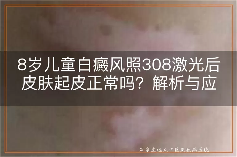 8岁儿童白癜风照308激光后皮肤起皮正常吗？解析与应对指南