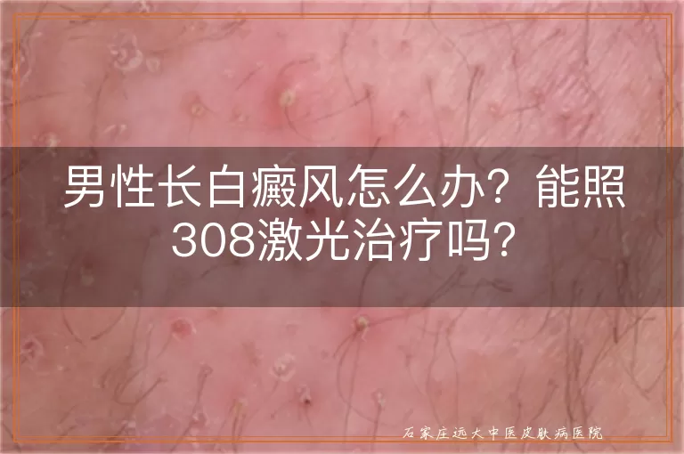 男性长白癜风怎么办？能照308激光治疗吗？