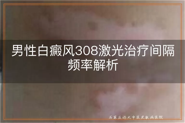 男性白癜风308激光治疗间隔频率解析
