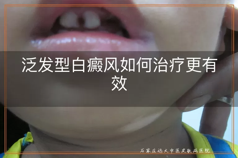 泛发型白癜风如何治疗更有效