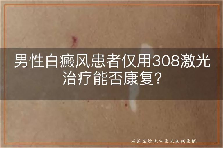 男性白癜风患者仅用308激光治疗能否康复？