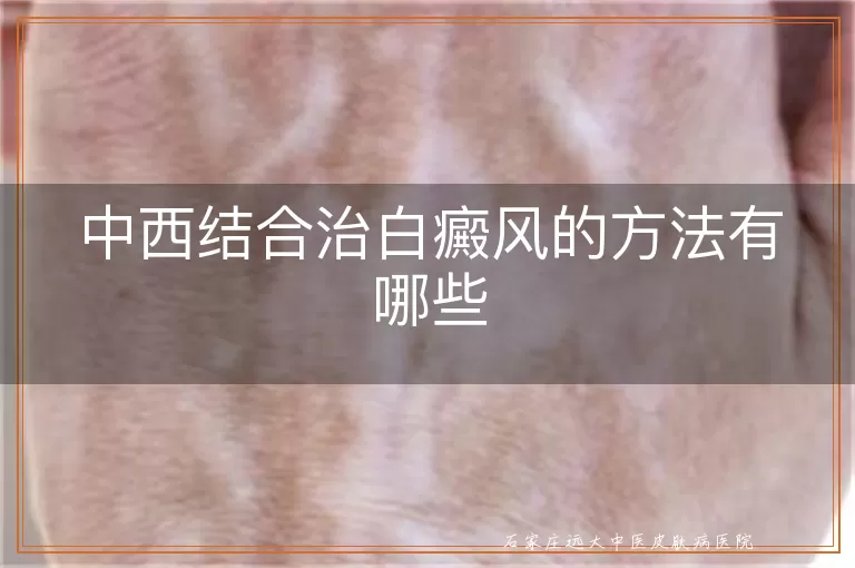 中西结合治白癜风的方法有哪些