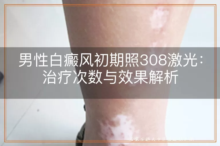 男性白癜风初期照308激光：治疗次数与效果解析