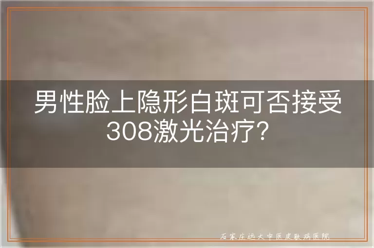 男性脸上隐形白斑可否接受308激光治疗？