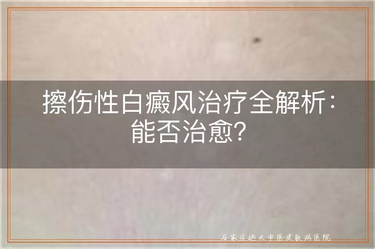 擦伤性白癜风治疗全解析：能否治愈？