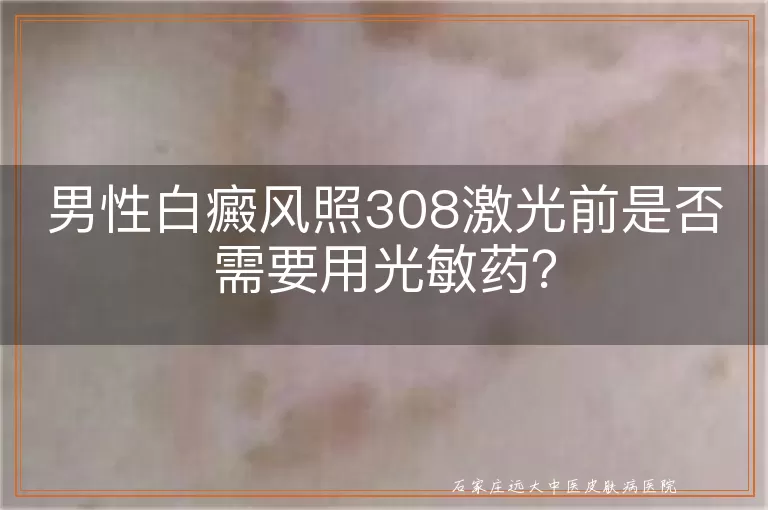 男性白癜风照308激光前是否需要用光敏药？