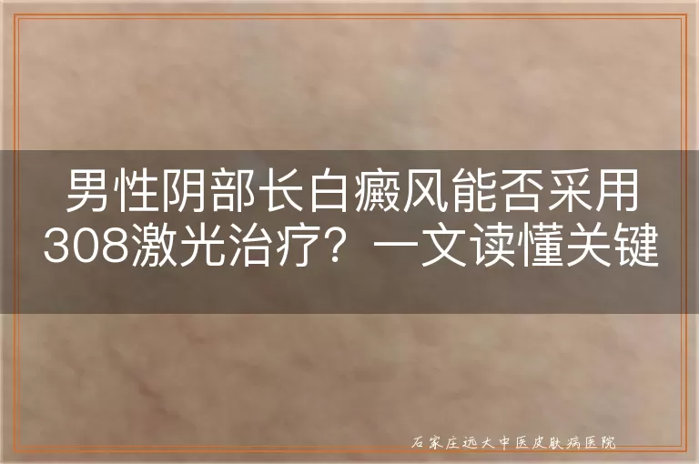 男性阴部长白癜风能否采用308激光治疗？一文读懂关键注意事项