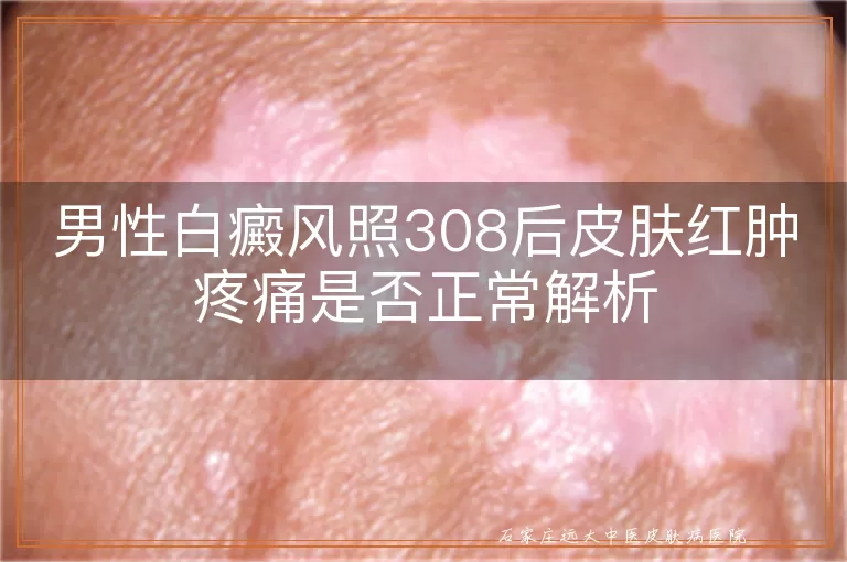 男性白癜风照308后皮肤红肿疼痛是否正常解析