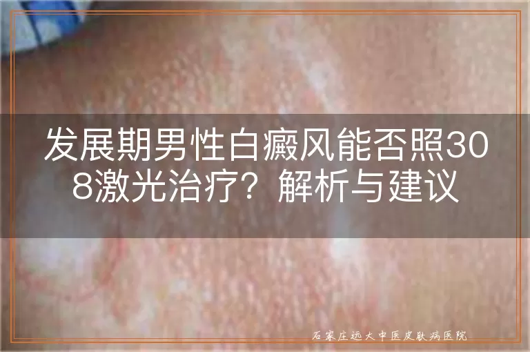 发展期男性白癜风能否照308激光治疗？解析与建议