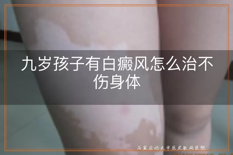 九岁孩子有白癜风怎么治不伤身体