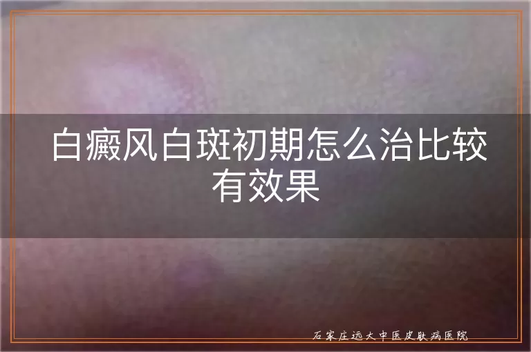 白癜风白斑初期怎么治比较有效果