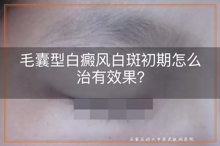 毛囊型白癜风白斑初期怎么治有效果？