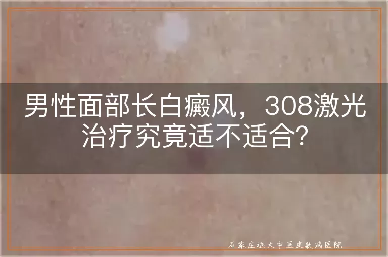 男性面部长白癜风，308激光治疗究竟适不适合？