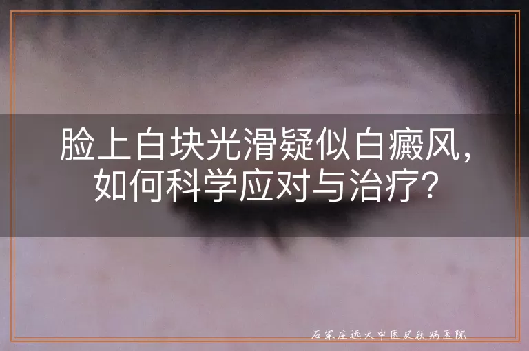 脸上白块光滑疑似白癜风，如何科学应对与治疗？