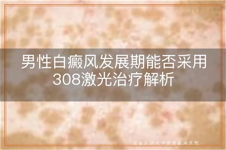 男性白癜风发展期能否采用308激光治疗解析