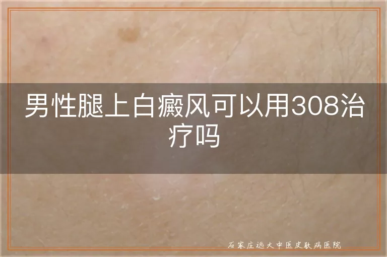 男性腿上白癜风可以用308治疗吗