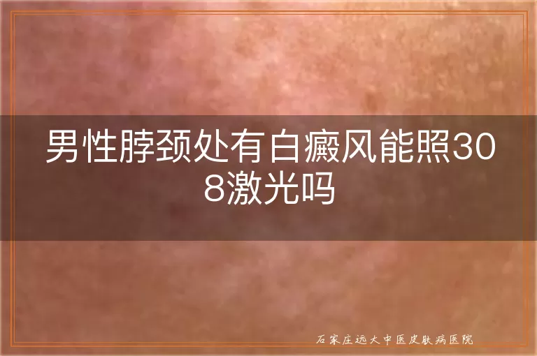 男性脖颈处有白癜风能照308激光吗