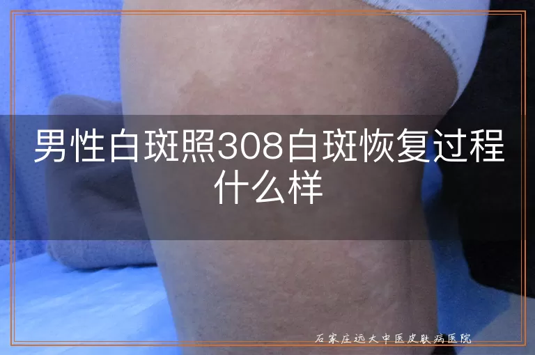 男性白斑照308白斑恢复过程什么样