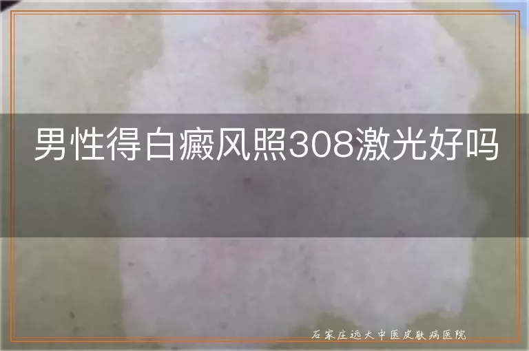 男性得白癜风照308激光好吗
